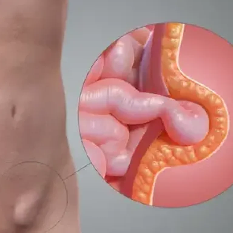 kasık-fıtığı-ameliyatı-bursa